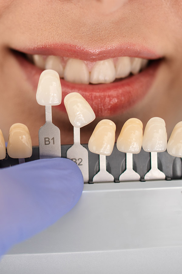 Kompositt veneers, porselen veneers, keramiske veneers